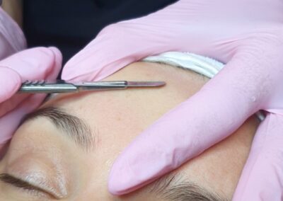 Dermaplaning